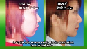 使用Tweed法的牙齒矯正前後比較,矯正前的下顎角度為94度(左),矯正後為88度。